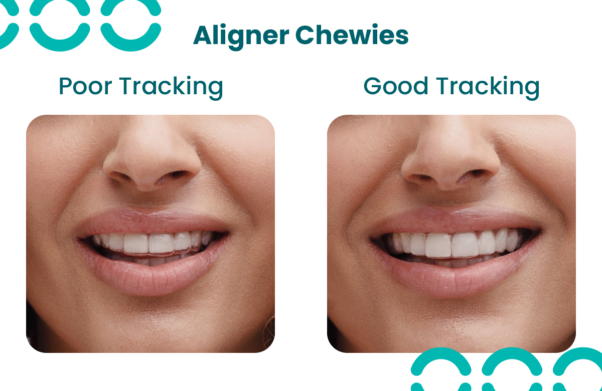 What Are Aligner Chewies Used For? The Key Benefits